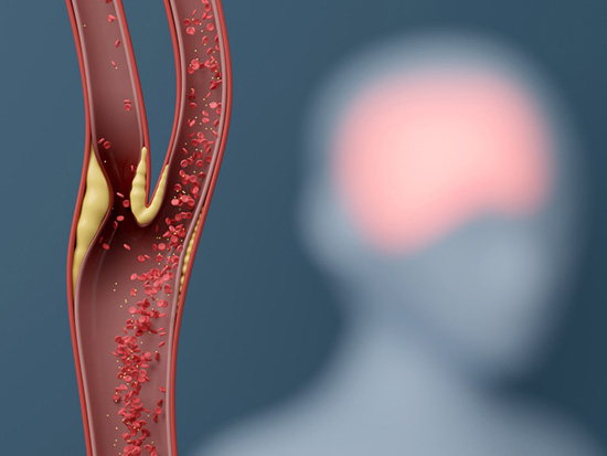 blood vessel and brain