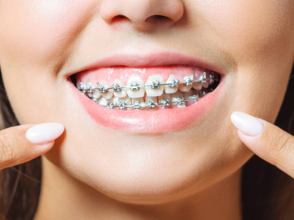Adobe Stock Image by Aleksandr Ryballko - Woman smiling with braces