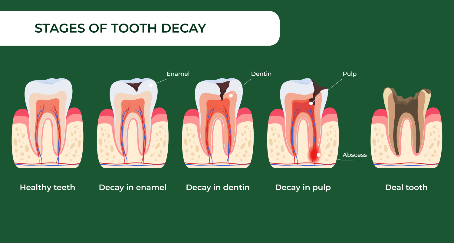 stages of tooth decay