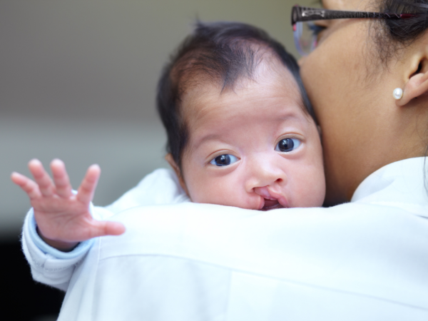 Woman holding child with cleft lip