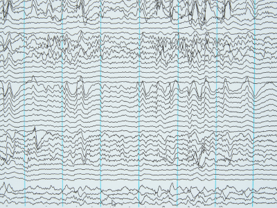 2017 Epilepsy News Article Lead Image