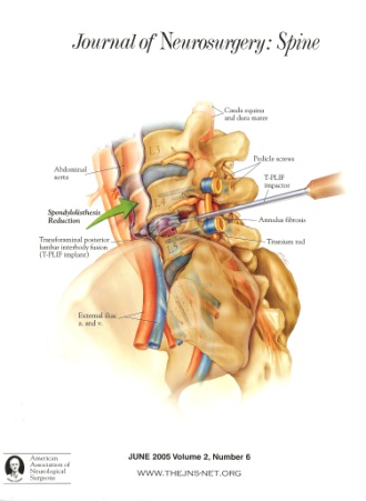 Guidelines for the Performance of Fusion Procedures for Degenerative Disease of the Lumbar Spine