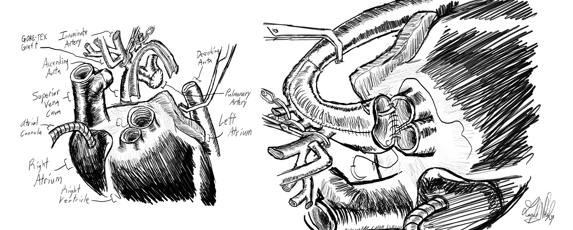 Sketches of a heart surgery procedure. Heart structures are labeled.