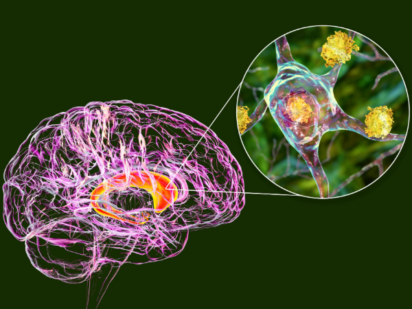 Huntington's disease