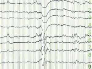 Study finds EEG biomarker to predict seizure onset in tuberous sclerosis patients