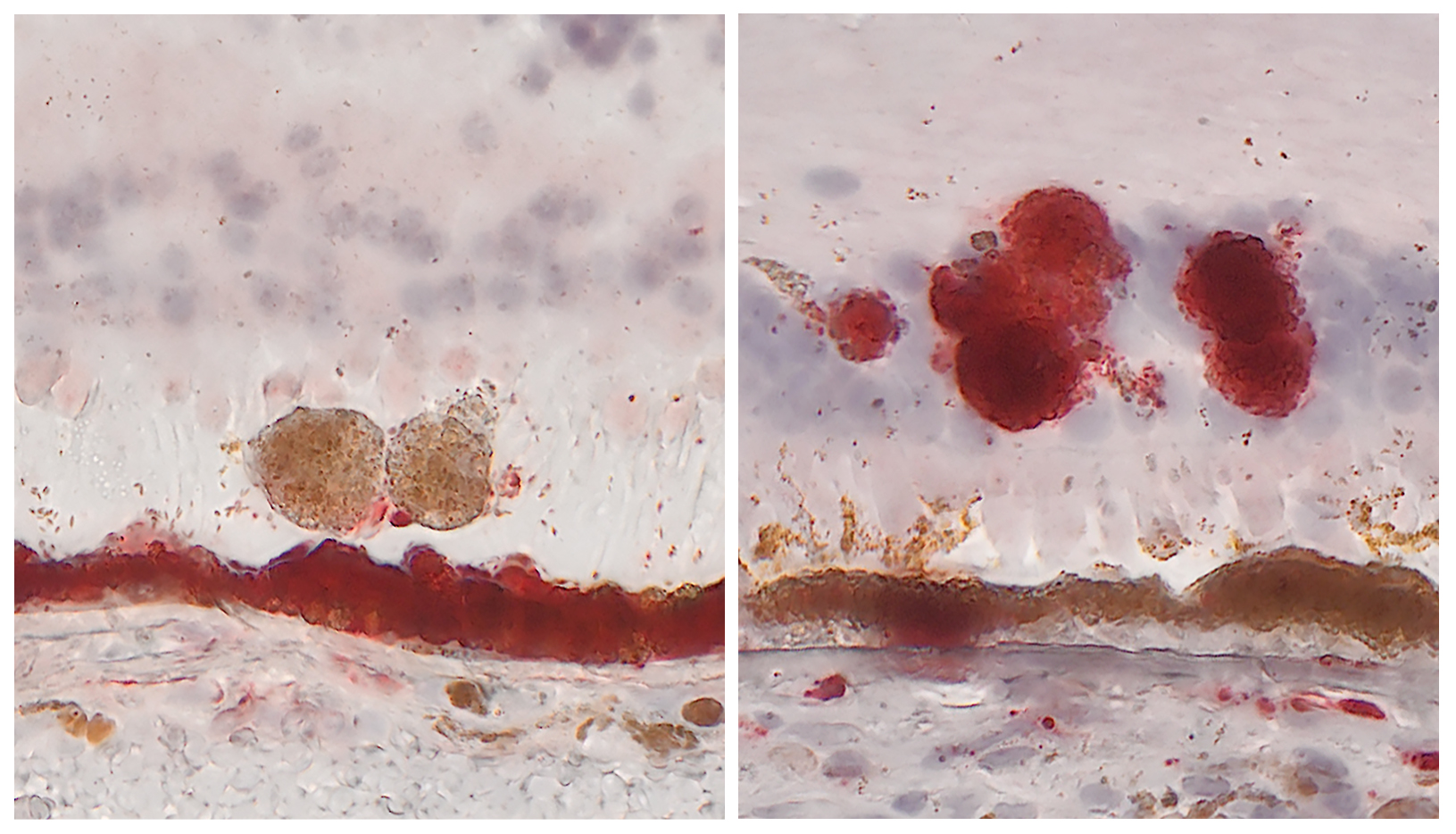 Five dimensions of age-related macular degeneration provide new insight