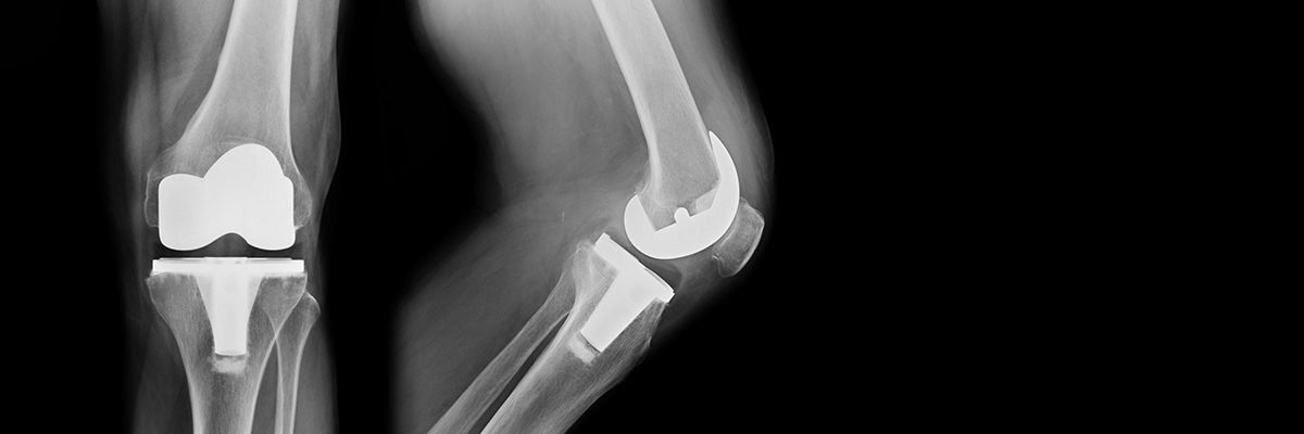 TKA x-ray, total knee replacement frontal and lateral view