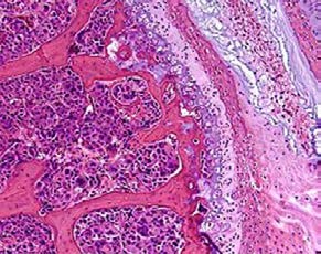 Figure 1.1 HE mouse spine EDTA decal metastatic breast cancer