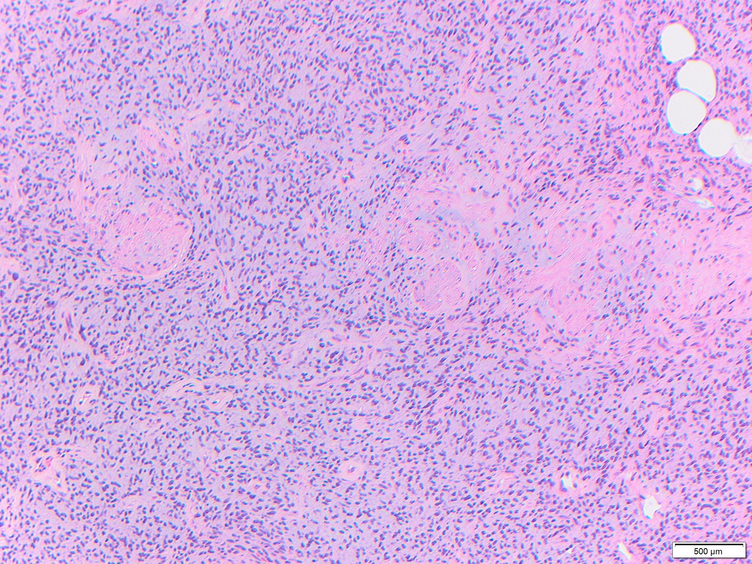 2 high power spindle cell proliferation with myoid bodies