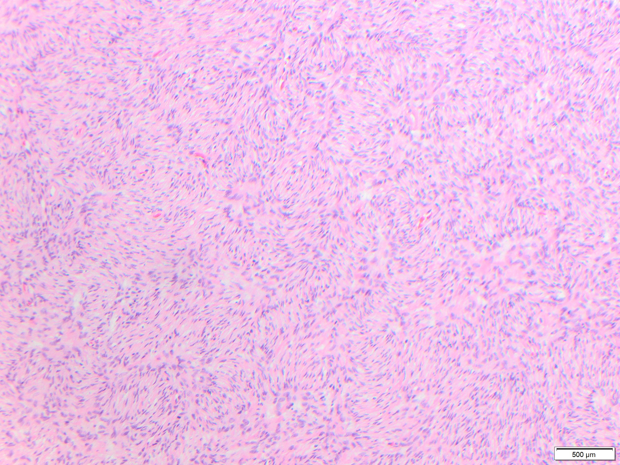 4 storiform pattern from excision specimen