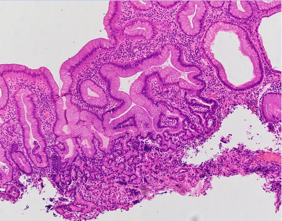 Autoimmune gastritis 10x