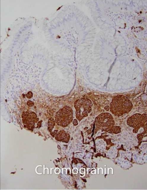 Chromogranin