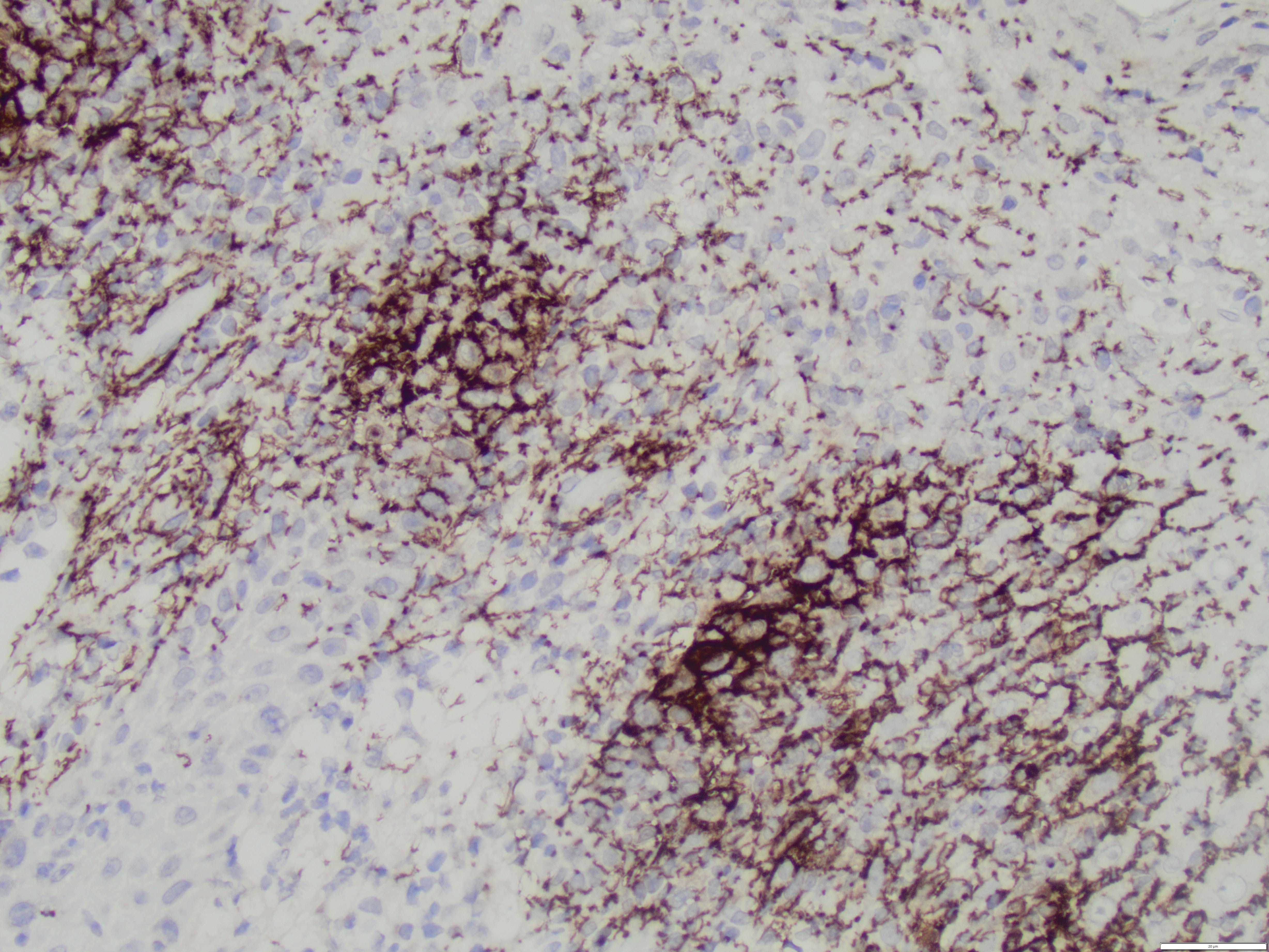 Condyloma Lata spirochete IHC high power1