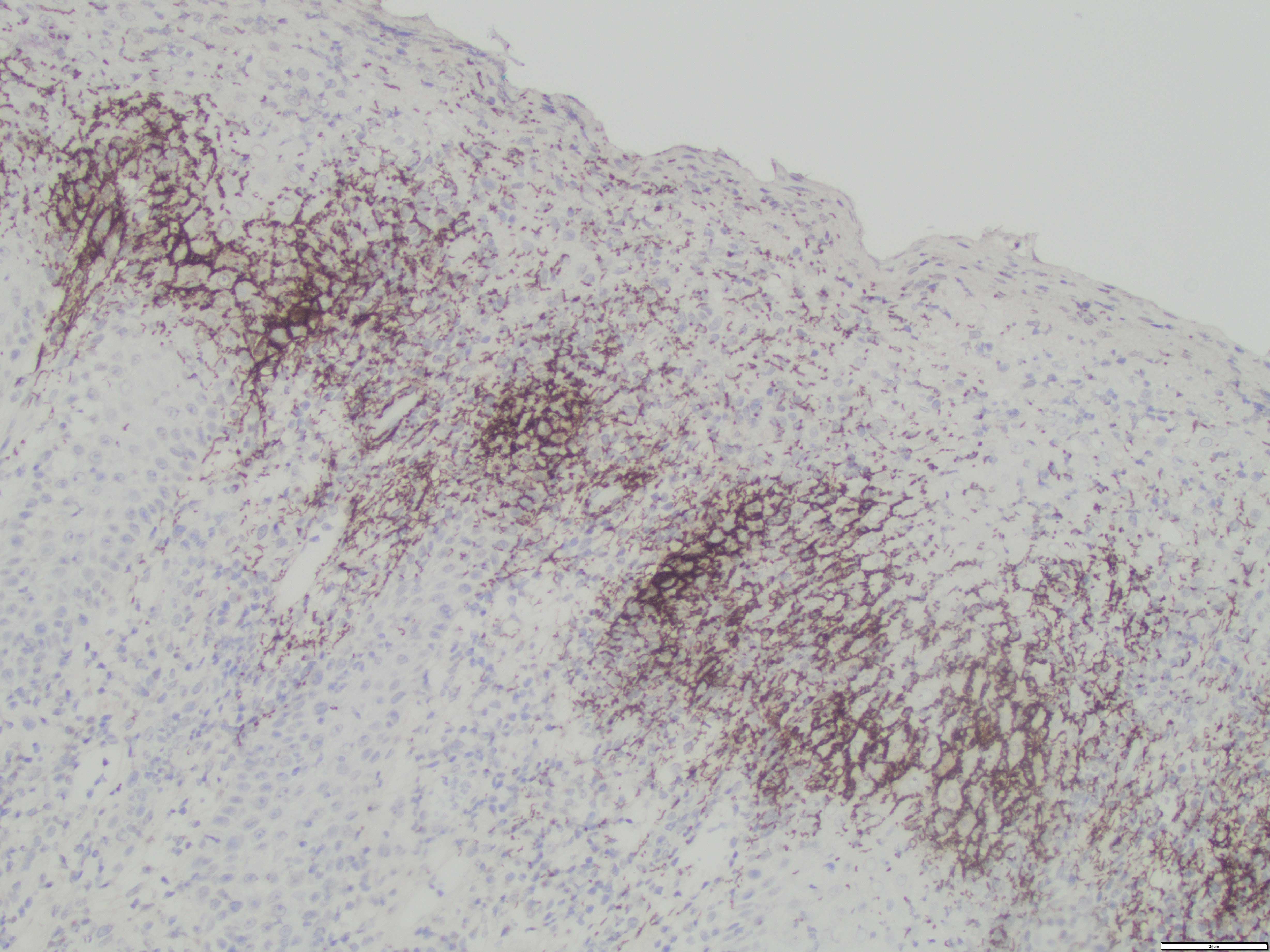 Condyloma Lata spirochete IHC low power1