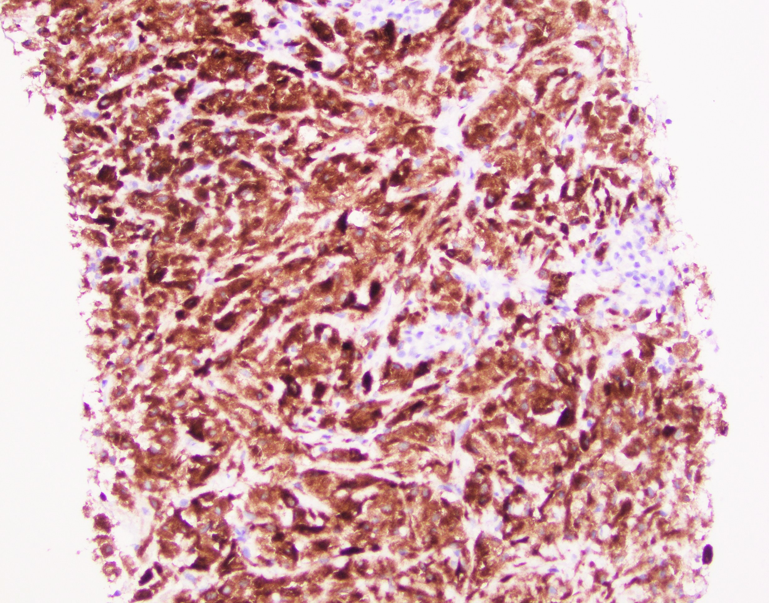 Condyloma Lata spirochete IHC high power1