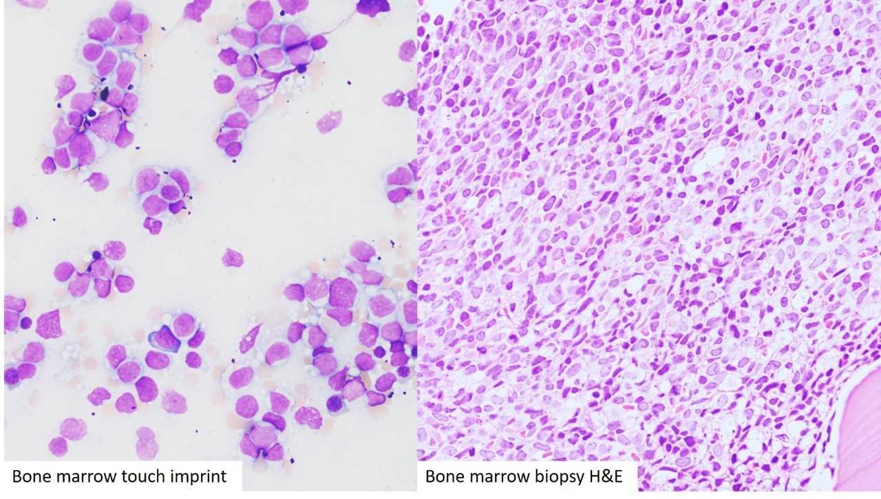 Question Photo 2 Bone marrow biopsy