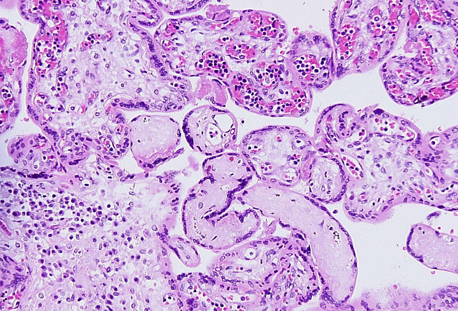 FIG 1 20x EBF sclerosis plasma cells Fe