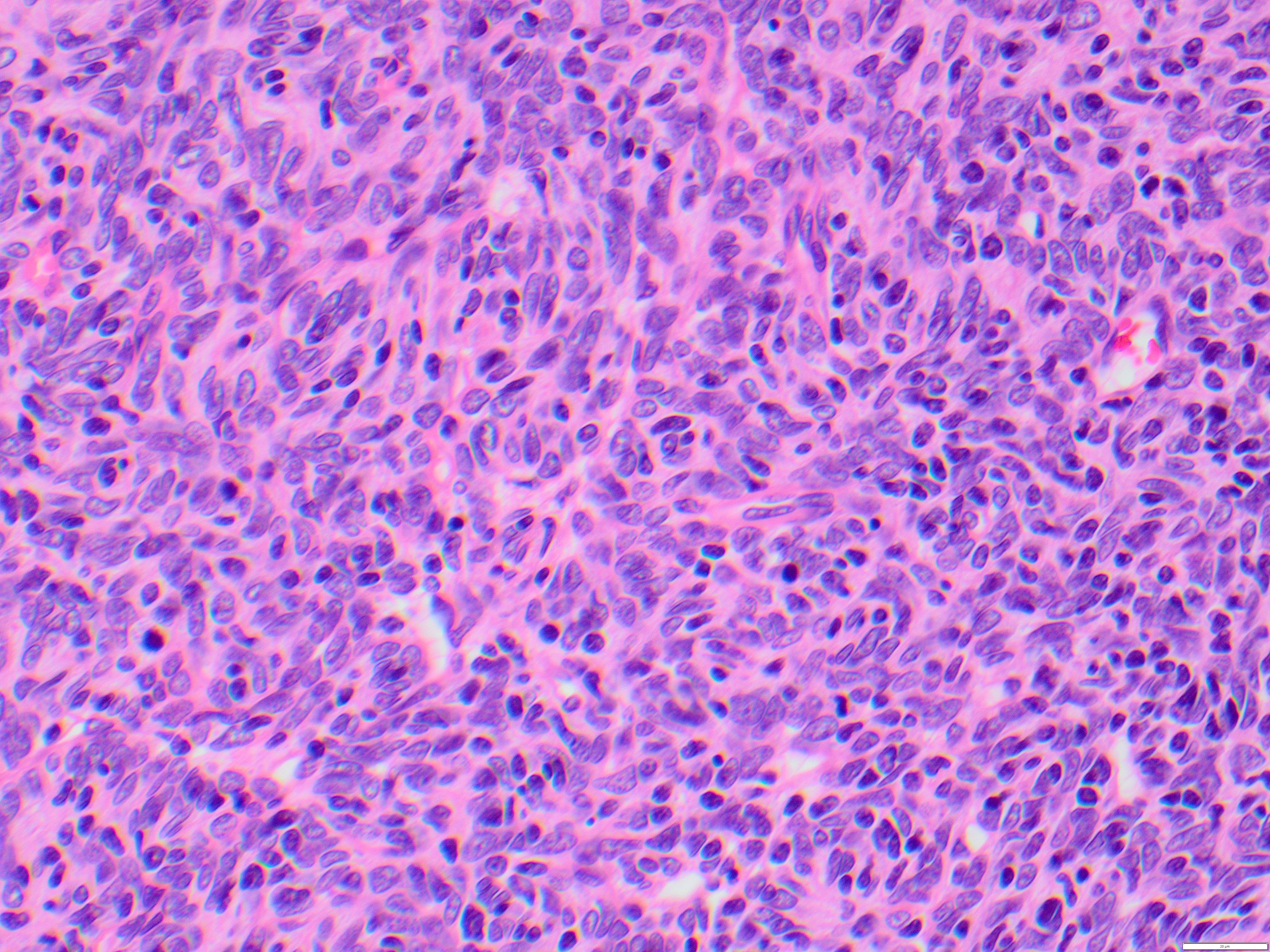 thymoma4