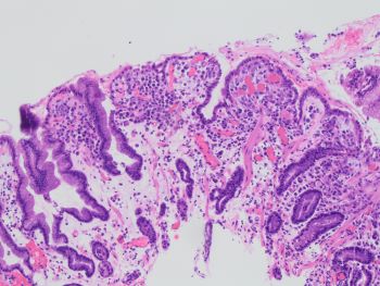 Metastatic_Lobular_Carcinoma_to_stomach_10x.jpg