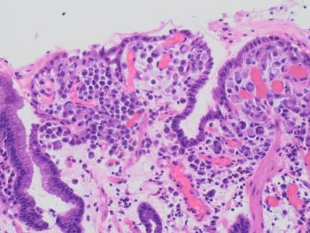 Metastatic_Lobular_Carcinoma_to_stomach_20x.jpg