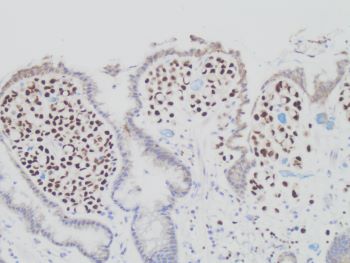 Metastatic_Lobular_Carcinoma_to_stomach_GATA3_20x.jpg