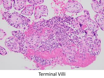 acute villitis and intervillositis HE 20x