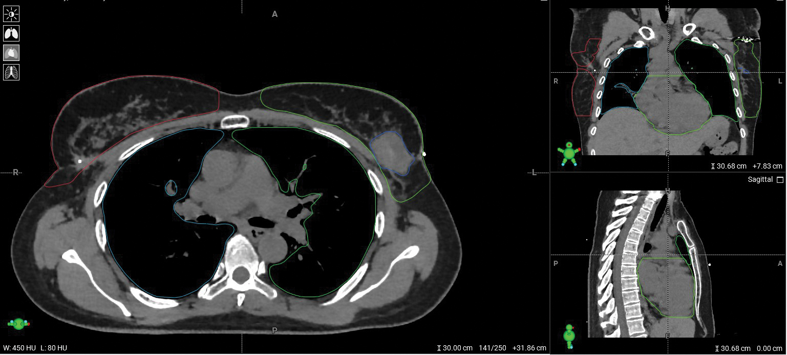 Breast Image 1