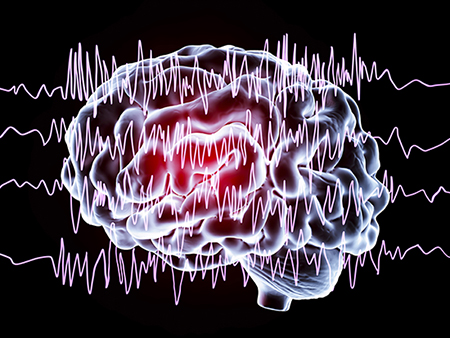 Brain and brain waves in epilepsy, computer illustration. This EEG (electroencephalogram) illustration shows generalized epilepsy, affecting the whole brain cortex: all the EEG traces show chaotic brain waves. Epilepsy can take many forms, and have different effects. This could illustrate both benign epilepsy (inherited childhood form that normally improves with age), and myoclonic epilepsy (form that causes muscle contractions). An EEG measures electrical activity in the brain using electrodes attached to the scalp.