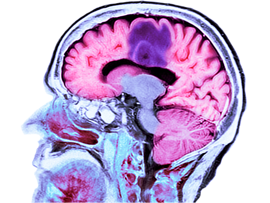 Glioblastoma stream