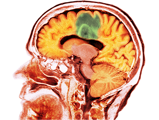 Glioblastoma brain cancer. Coloured computed tomography (CT) scan of a section through the brain of an 84-year-old female patient with glioblastoma (dark, top). Glioblastoma is the most aggressive form of brain cancer. Treatment involves surgery, after which chemotherapy and radiation therapy are used. However, the cancer usually reoccurs despite treatment and the most common length of survival after diagnosis is 12-15 months. Without treatment, survival is typically 3 months.