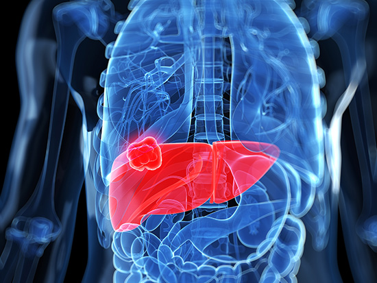 Liver cancer, computer artwork.