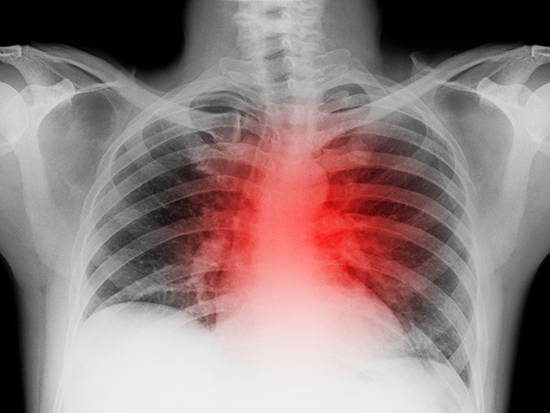 X-ray of lung with heart attack