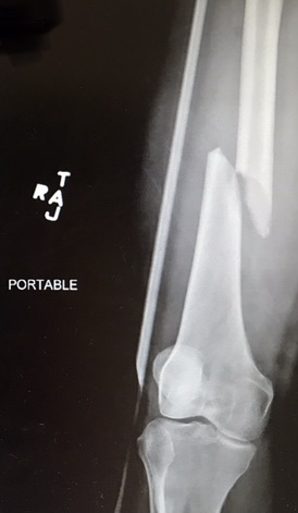 arrington 3 fracture