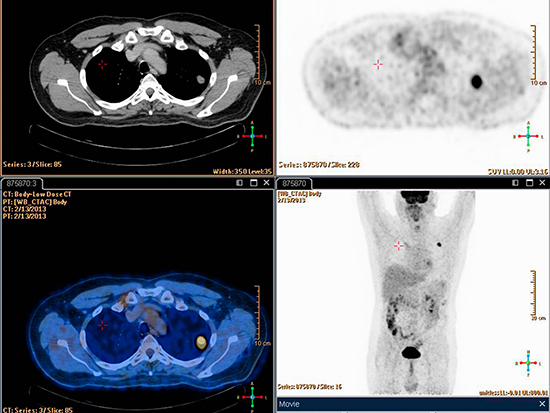 PET Scan