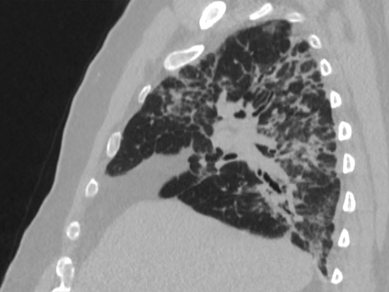 Post-COVID lung fibrosis , 3 months after acute infection