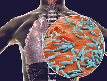 Secondary tuberculosis infection and close-up view of Mycobacterium tuberculosis bacteria, the causative agent of tuberculosis. Computer illustration showing small-sized solid nodular mass located in the upper lobe of right lung near lung apex.