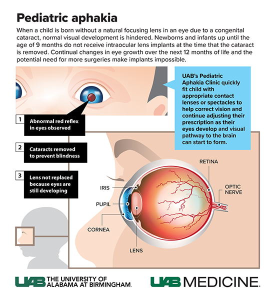 small Aphakia Eye graphic Kennamer 2