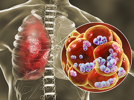 Pneumococcal pneumonia. Computer illustration of Streptococcus pneumoniae (pneumococci) bacteria inside the alveoli of the lungs, causing pneumonia.