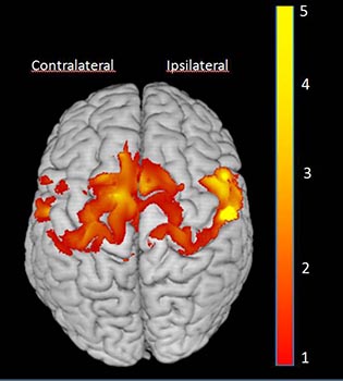 CI_therapy_grey_matter_s