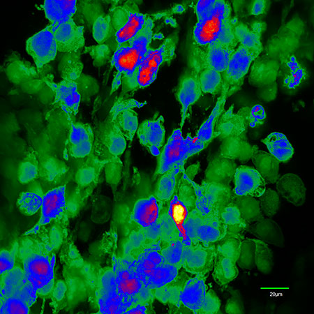 Glioma cells in vivo