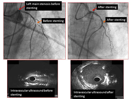 Left-main-stenosis 2