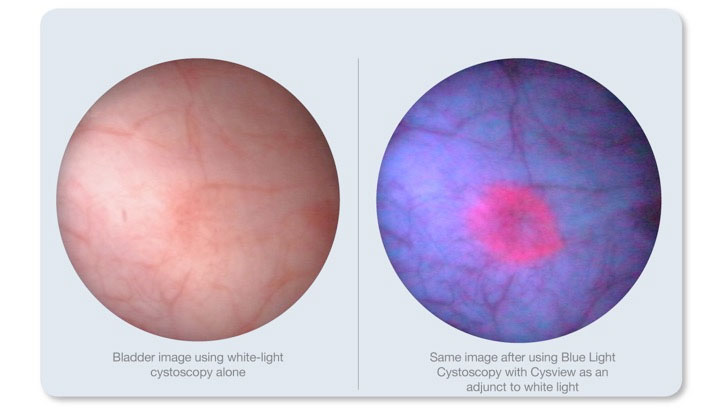 cystoscopy web