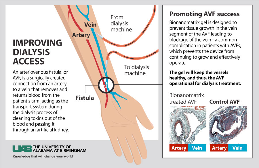 dialysis graphic 2 new