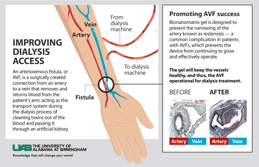 dialysis graphic horizontal