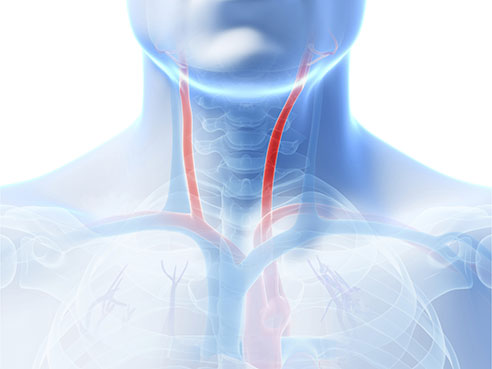 howard stroke risk