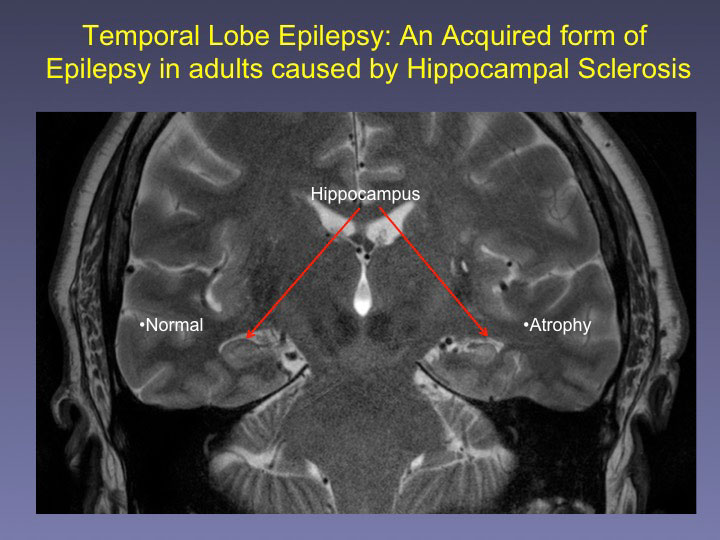 lubin epilepsy