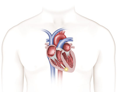 Nanostim in heart sized