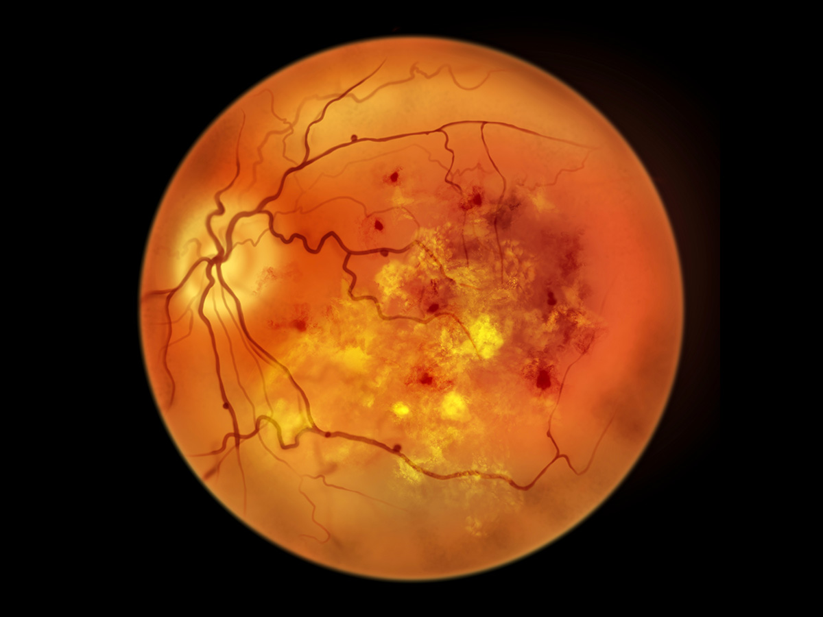 Digital scan of a retina impacted by diabetic retinopathy.