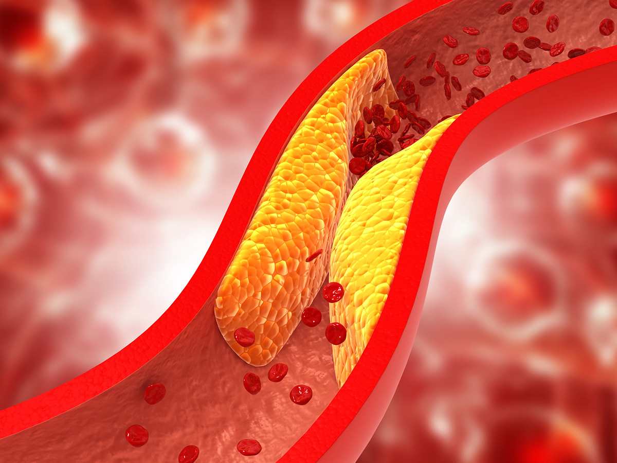 Graphic showing the buildup of fat in artery walls, restricting blood flow