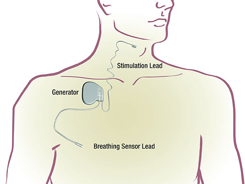 sleep apnea